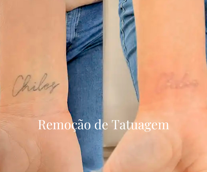 PREENCHIMENTO LABIAL (4)