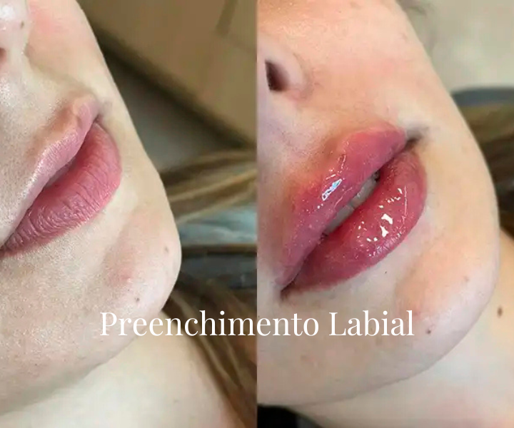 PREENCHIMENTO LABIAL (7)