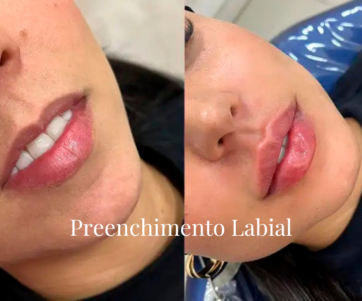 PREENCHIMENTO LABIAL (8)