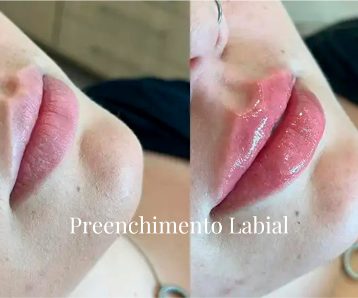 PREENCHIMENTO LABIAL (9)