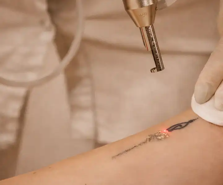 Remoção de Tatuagem em São Paulo